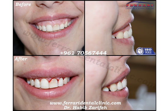 Gummy Smile correction for complicated cases